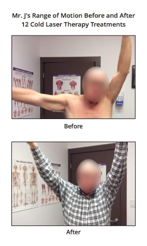 cold laser therapy for tennis elbow