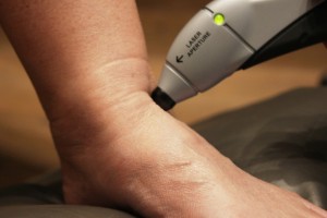 Cold Laser Therapy Ankle Pain Treatment: Step 3